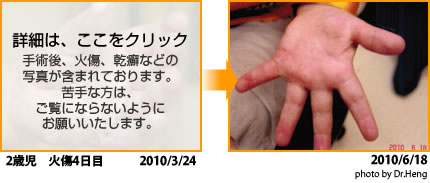 火傷（やけど）